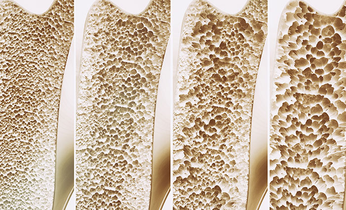 Osteoporosis Bone