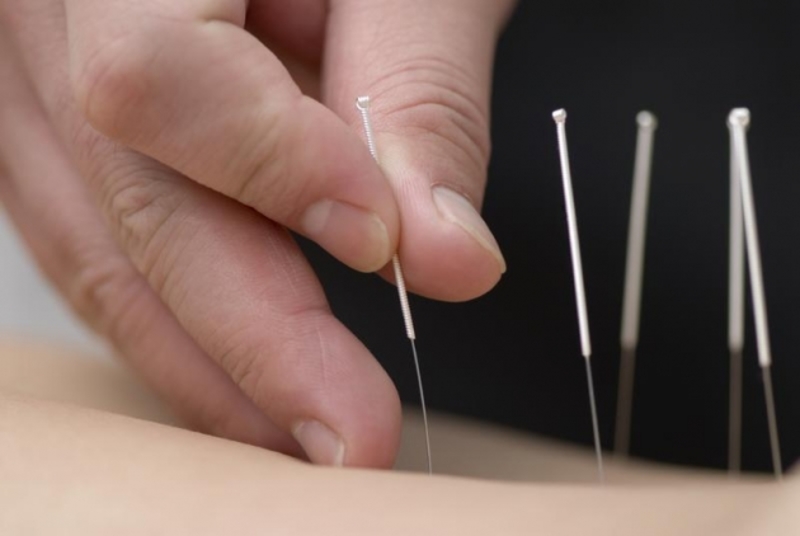 acupuncture 2